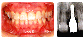 人の歯の写真