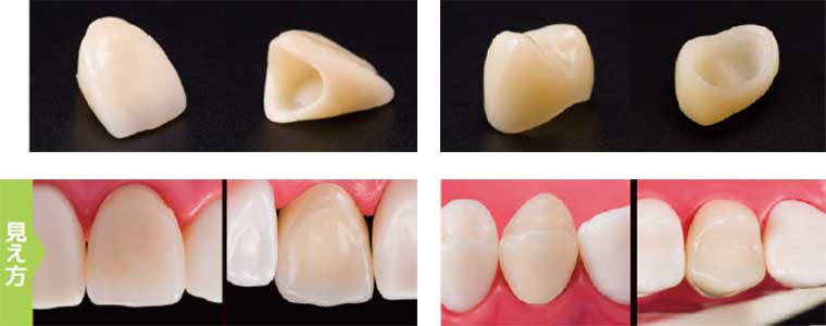 CAD/CAMで作製した前歯と小臼歯の被せ物の写真と仕上がりの見え方