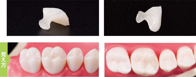 CAD/CAMインレーで作製した歯の被せ物の写真と奥歯の仕上がりの見え方