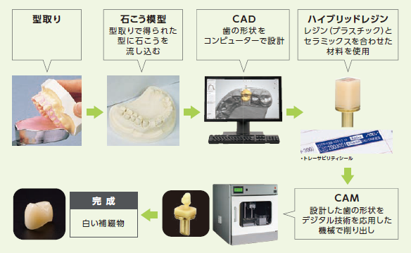 型取り、石こう模型、CAD（歯の形状をコンピュータで設計）、ハイブリッドレジンを材料に、CAM（CADのデジタルデータを機械で削り出し）、完成。