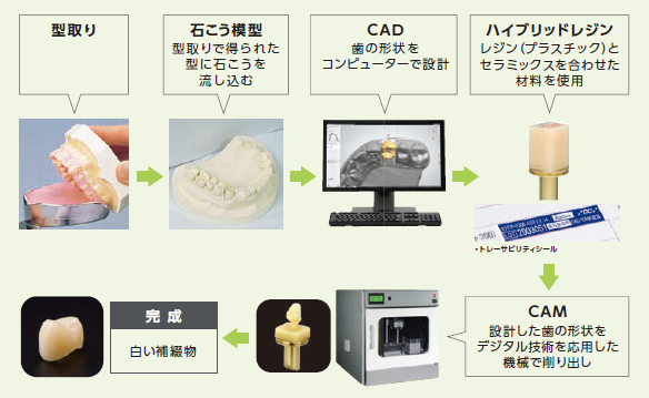 型取り、石こう模型、CAD(歯の形状をコンピュータで設計)、ハイブリッドレジンを材料に、CAM(CADのデジタルデータを機械で削り出し)、完成。